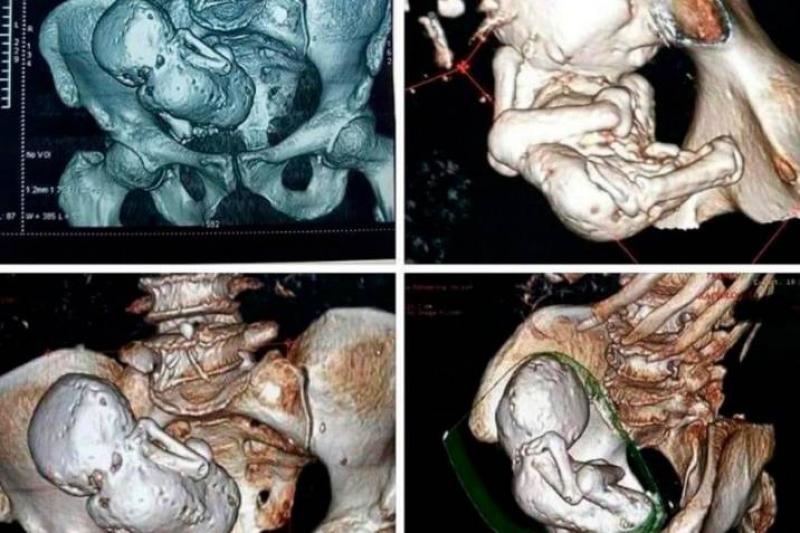 Anciana dejó en shock a doctores con lo que llevaba dentro del vientre: un bebé de piedra